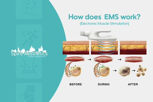 EMS treatment for post pregnancy weight loss treatment Coatbridge