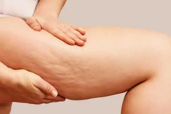 Image of woman showing leg with cellulite Coatbridge