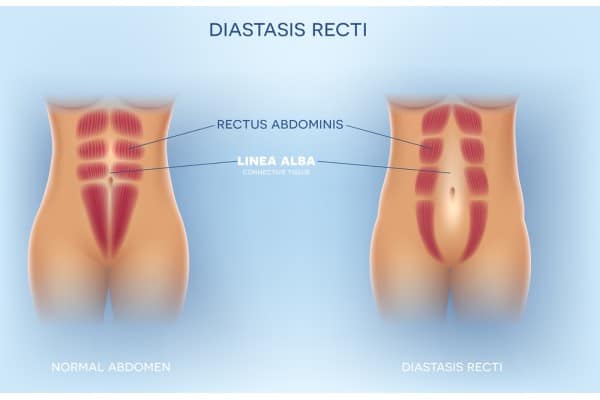 What Non-Surgical Options Are Available for Diastasis Recti Coatbridge?