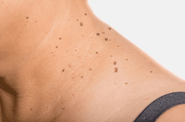 Are you looking for easy skin tag removal Coatbridge - then contact Spire today!