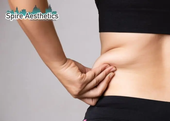 Image of woman pinching fat on their hips Coatbridge. Fat Freezing treatment