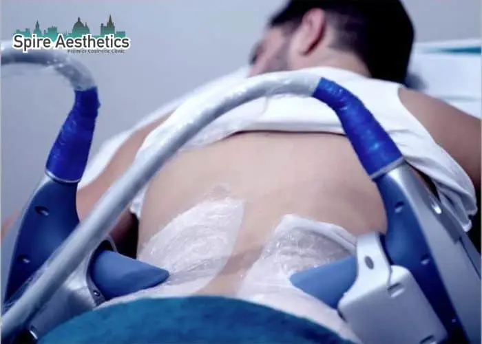 Man having fat freezing treatment done on love handles before a competitions Coatbridge to create a sculpted look.