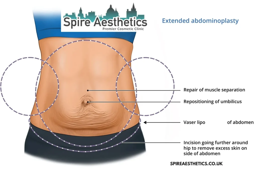Understanding Loose Skin After Gastric Band Coatbridge Surgery and HIFU Treatment