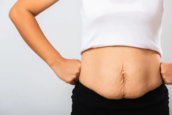 Image of a woman's stomach after weight loss with sagging skin following a gastric band Coatbridge