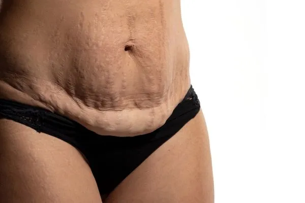 Image of womans stomach after weight loss injections Coatbridge showing saggy skin