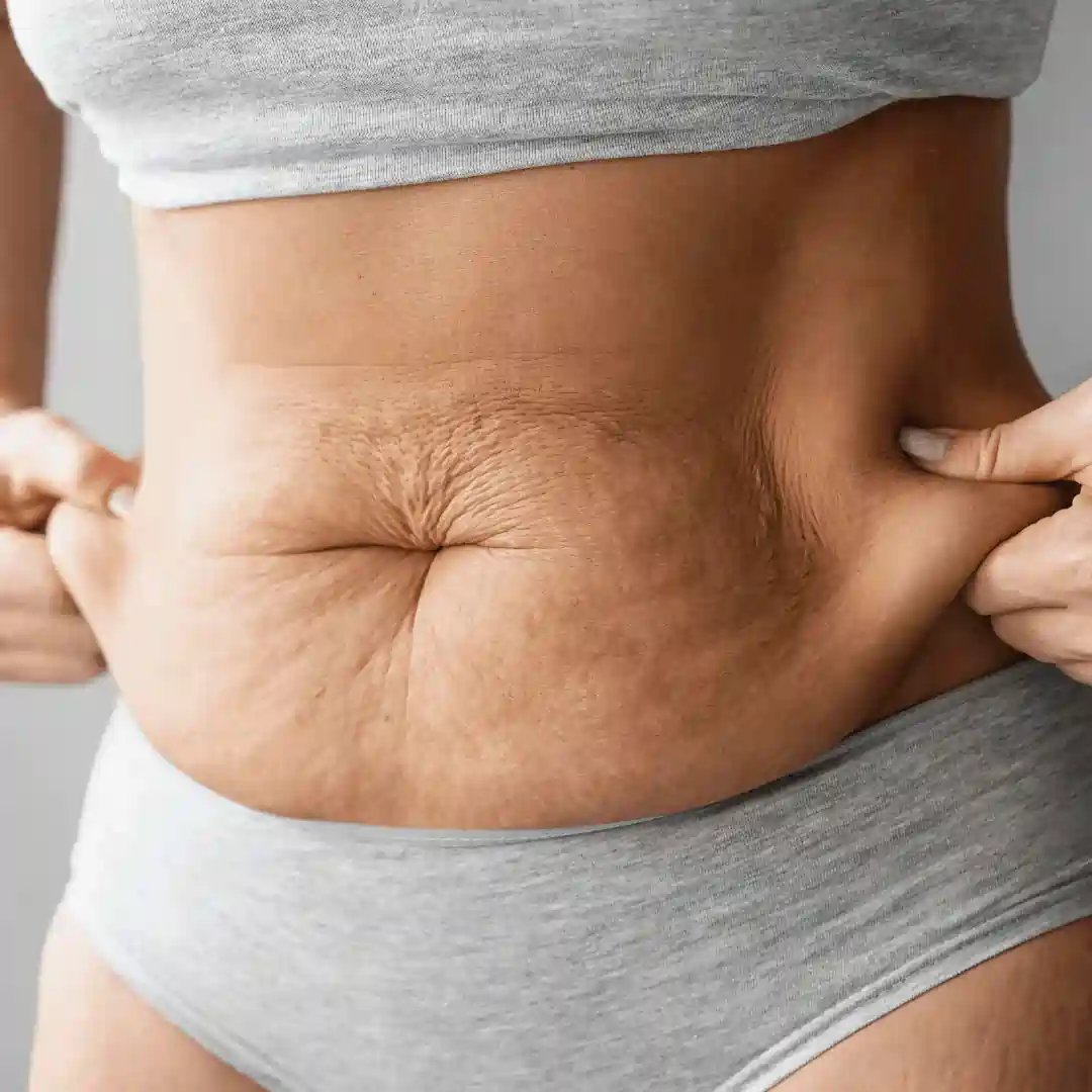 Is It Normal to Have Loose Skin After Pregnancy Coatbridge?